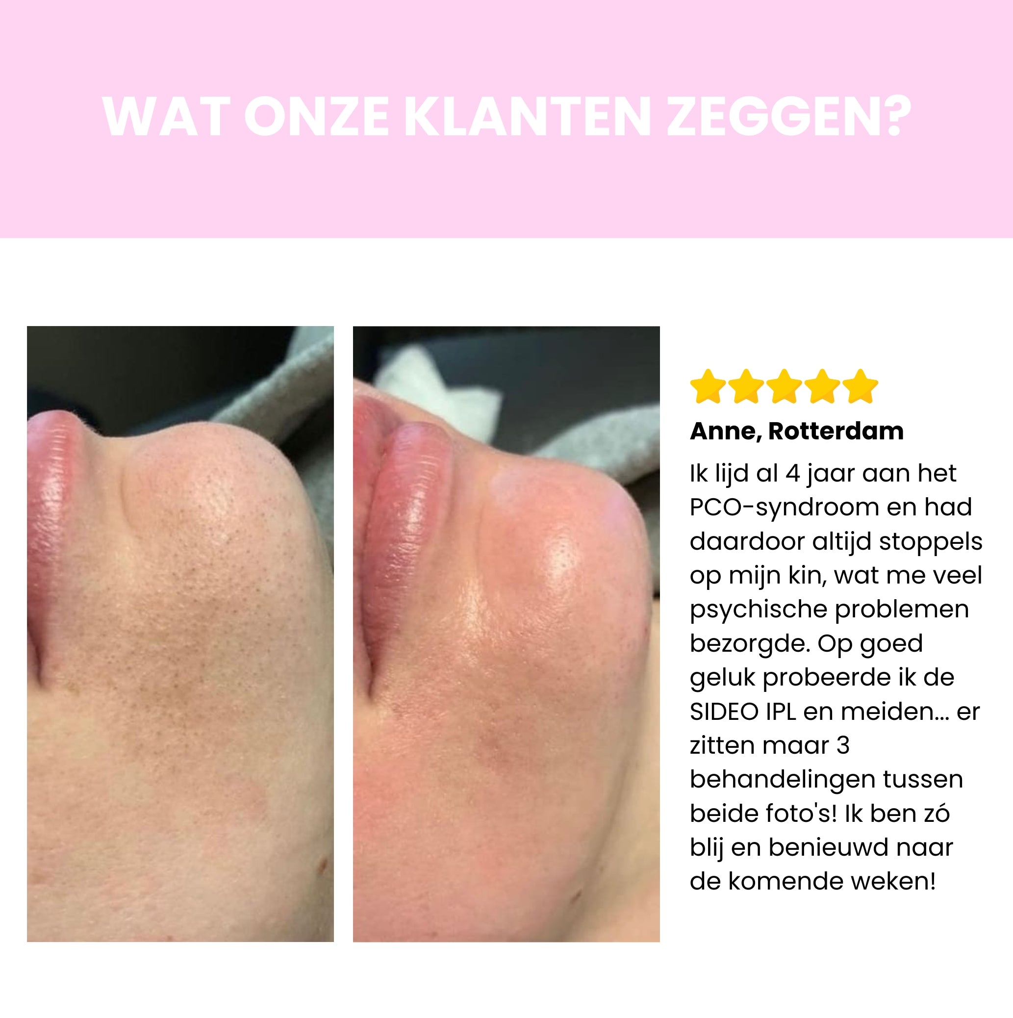 Sideo IPL Haarverwijderaar – Professionele laserontharing voor thuisgebruik