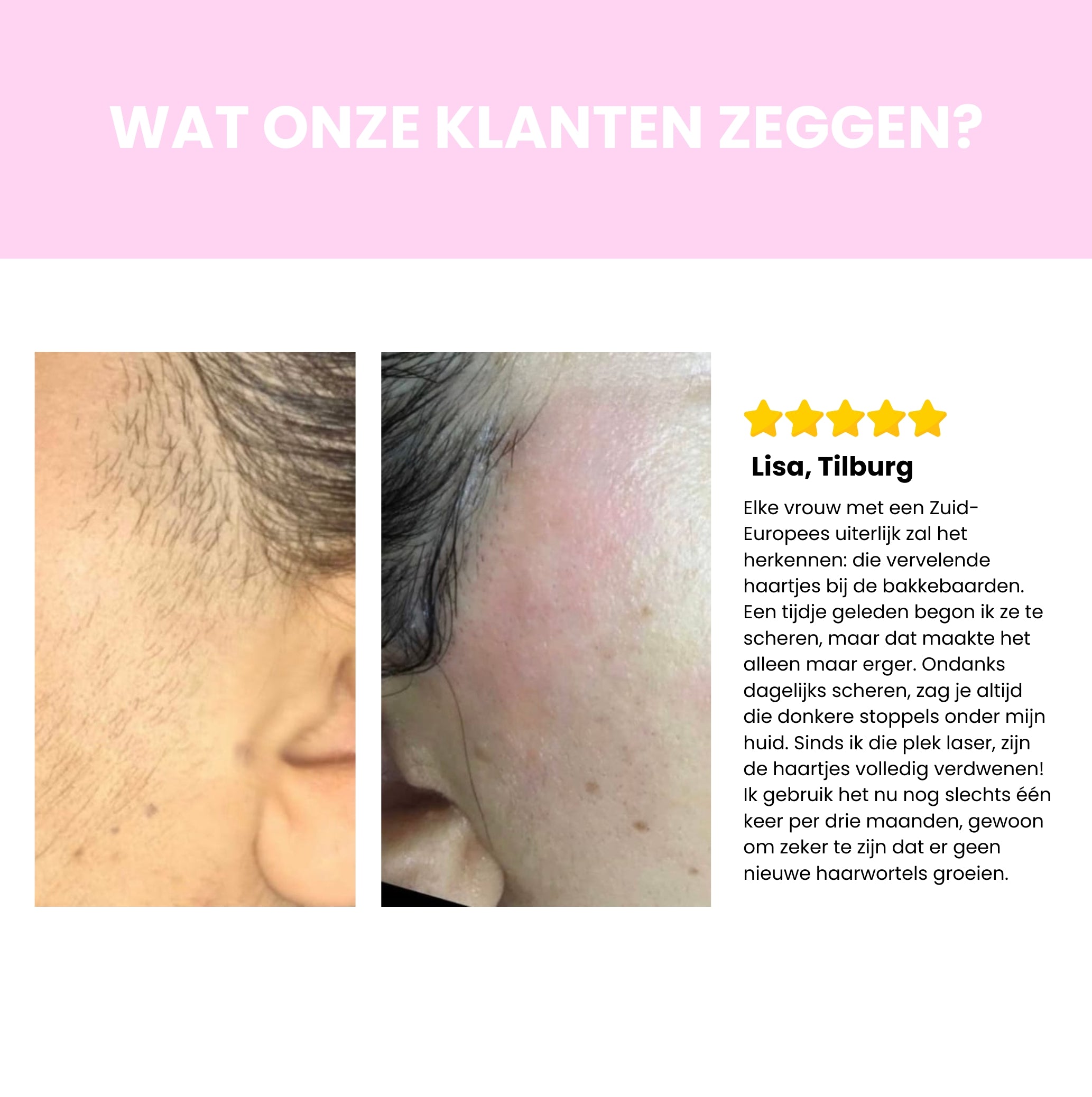 Sideo IPL Haarverwijderaar – Professionele laserontharing voor thuisgebruik
