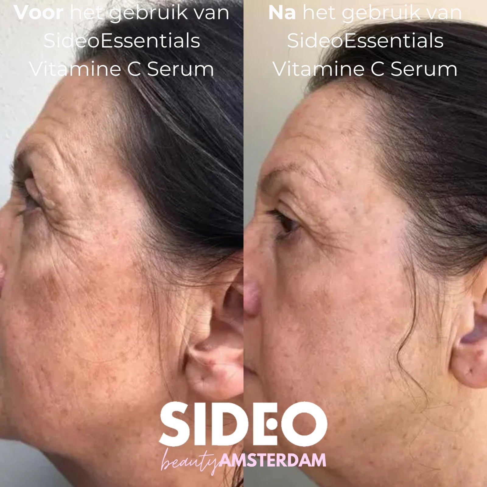 Het Virale SideoEssentials™ Vitamine C Serum