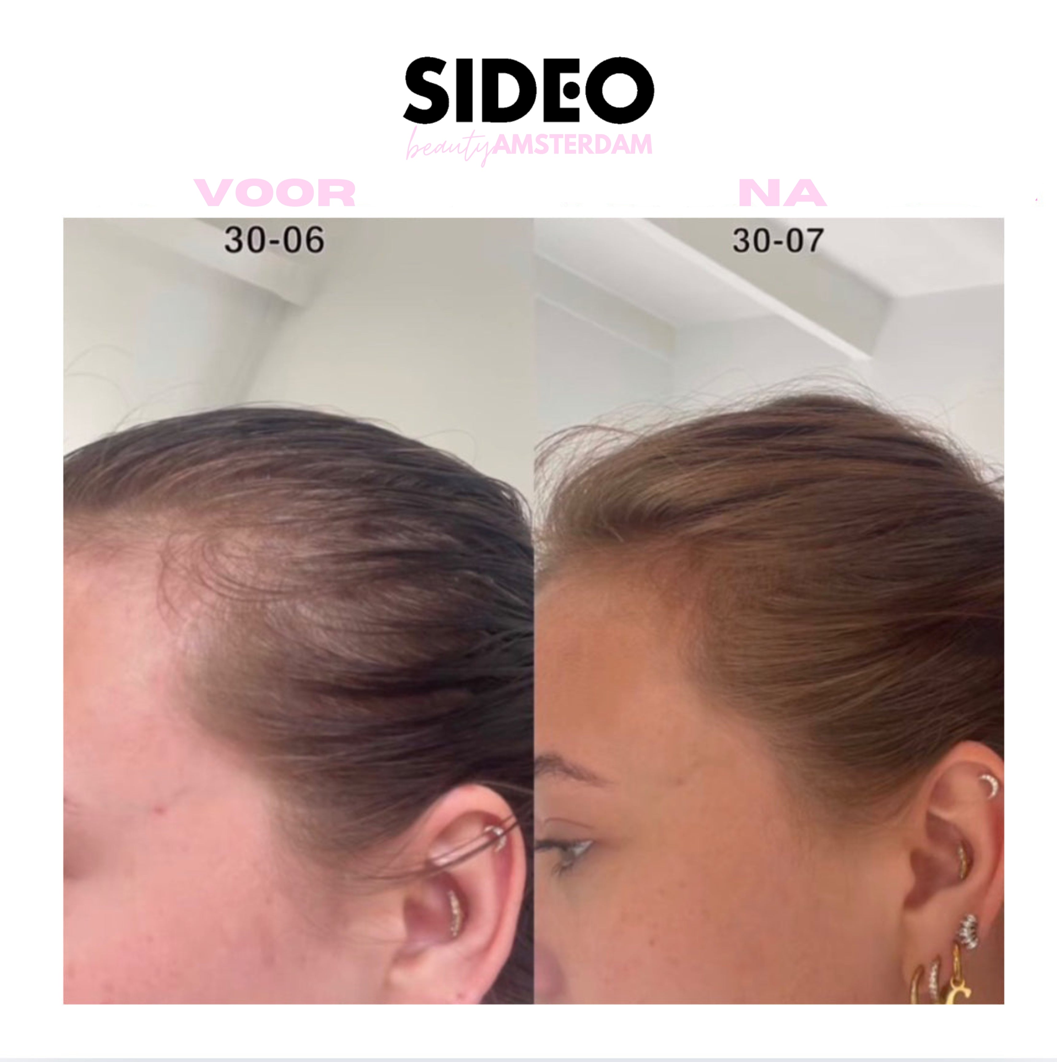 De Virale SideoEssentials™ Haargroeiolie