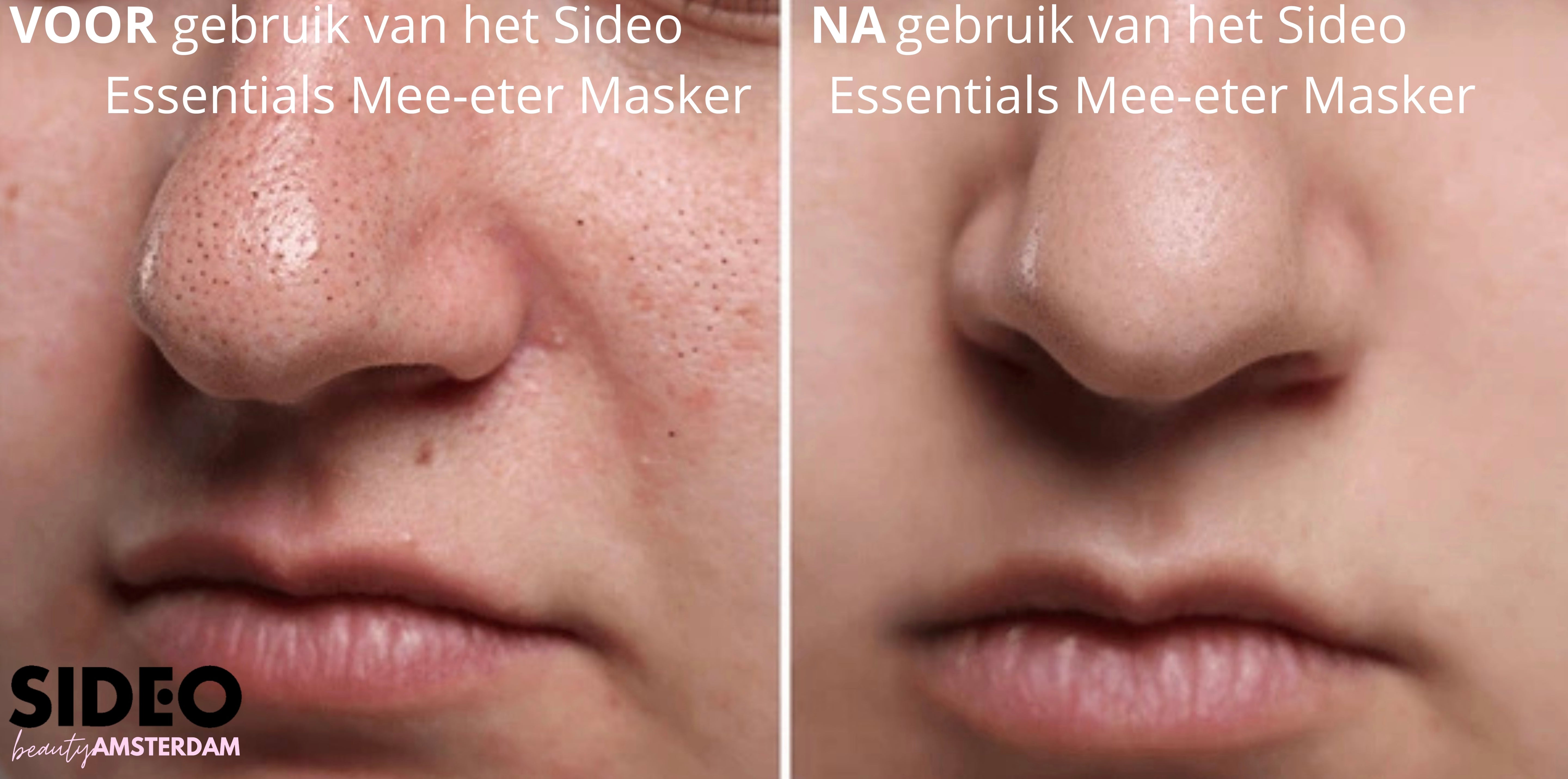 Mee-etermasker - Diepe Reiniging voor een Zichtbaar Gladde Huid