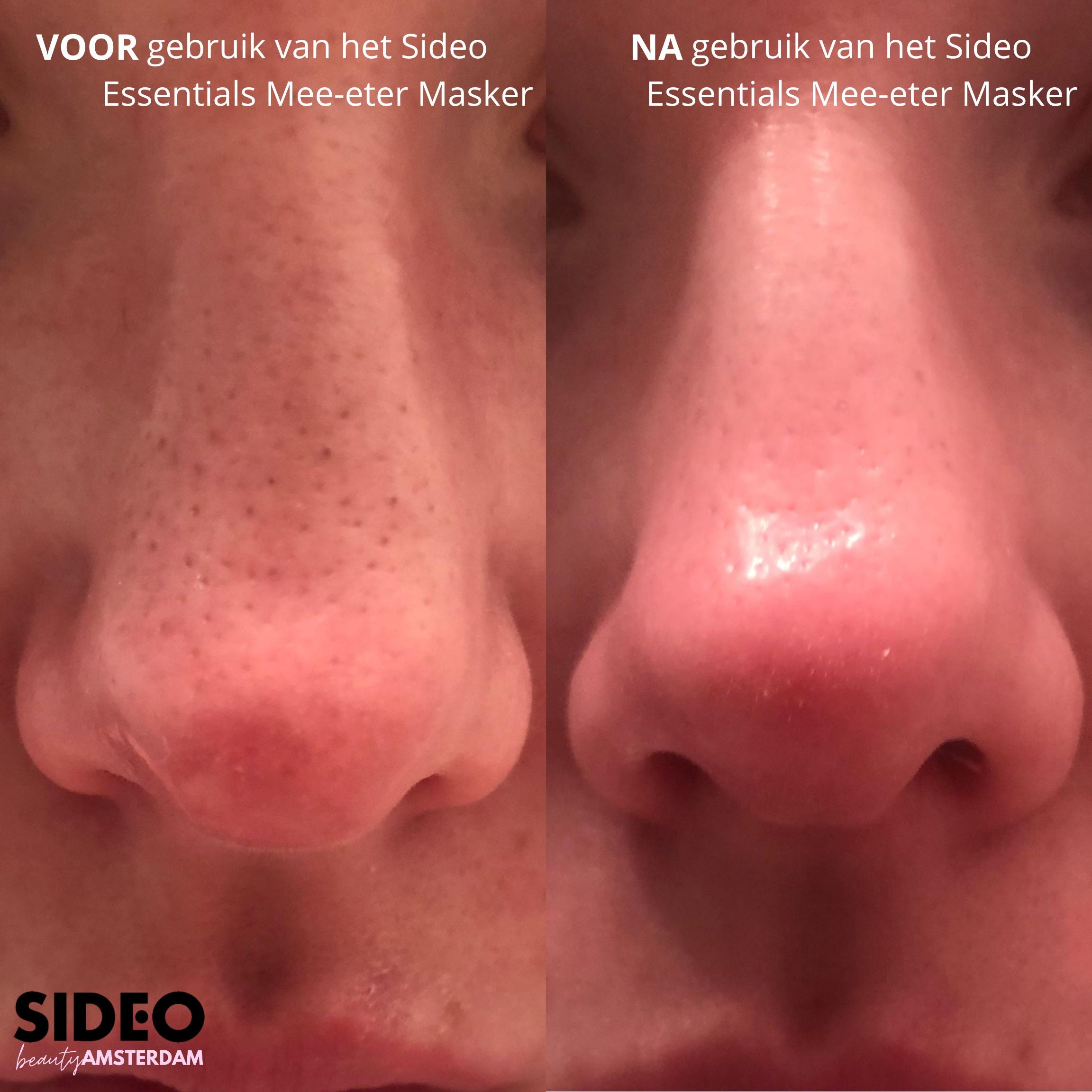 Mee-etermasker - Diepe Reiniging voor een Zichtbaar Gladde Huid