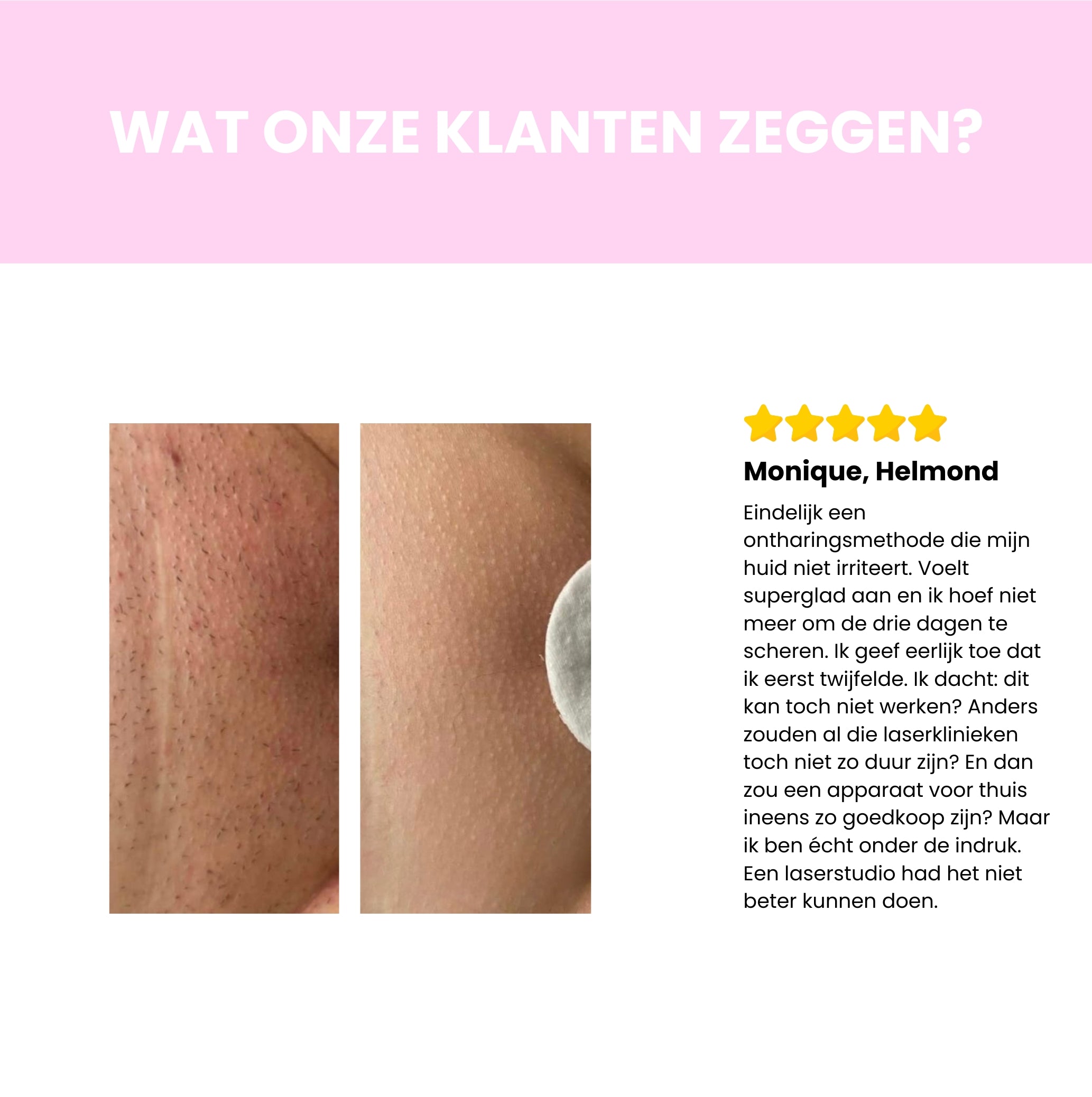 Sideo IPL Haarverwijderaar – Professionele laserontharing voor thuisgebruik
